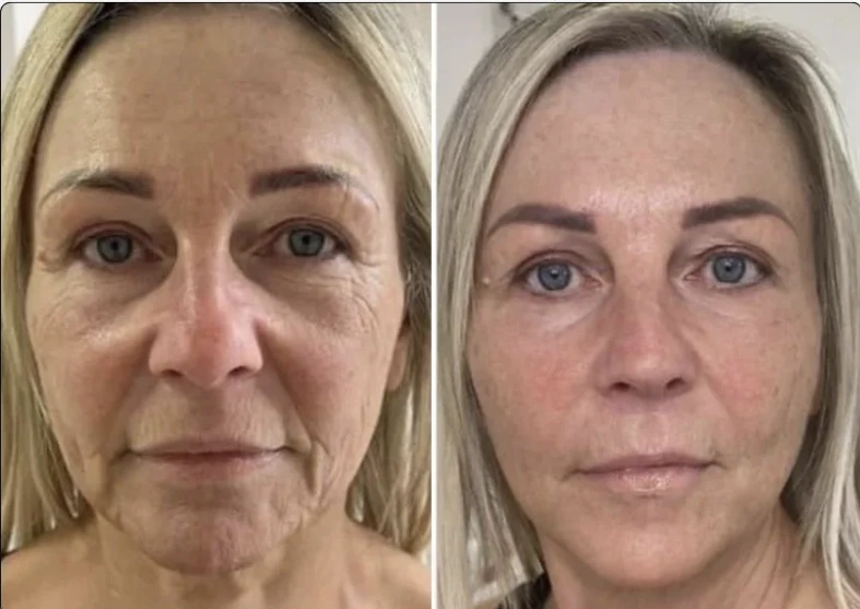 Resultado después del tratamiento de arrugas