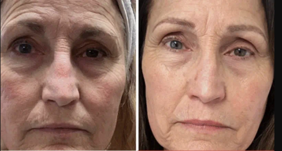 Resultado después del tratamiento anti-edad