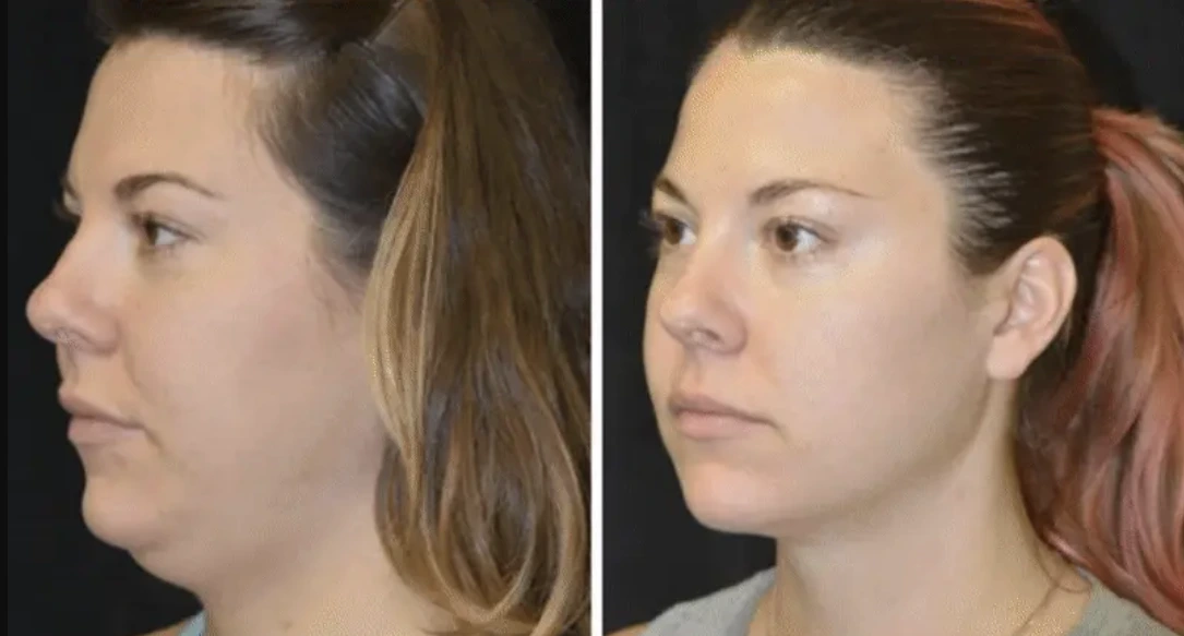 Resultado después del tratamiento de papada